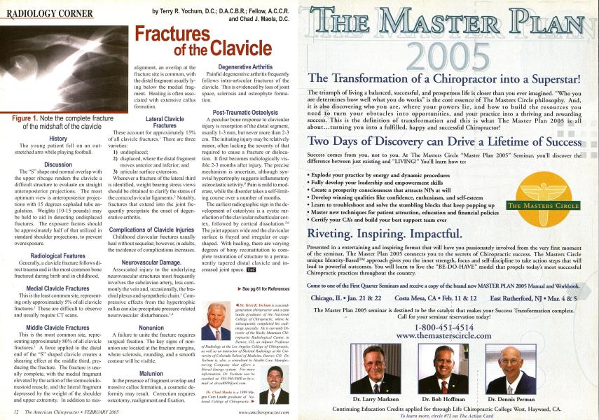 Fractures of the Clavicle