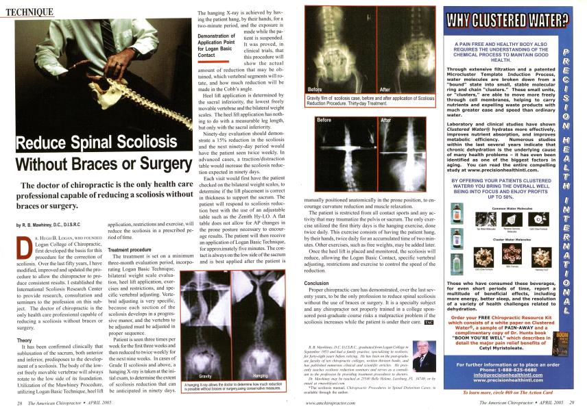 Reduce Spinal Scoliosis Without Braces or Surgery