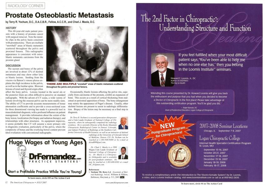 Prostate Osteoblastic Metastasis