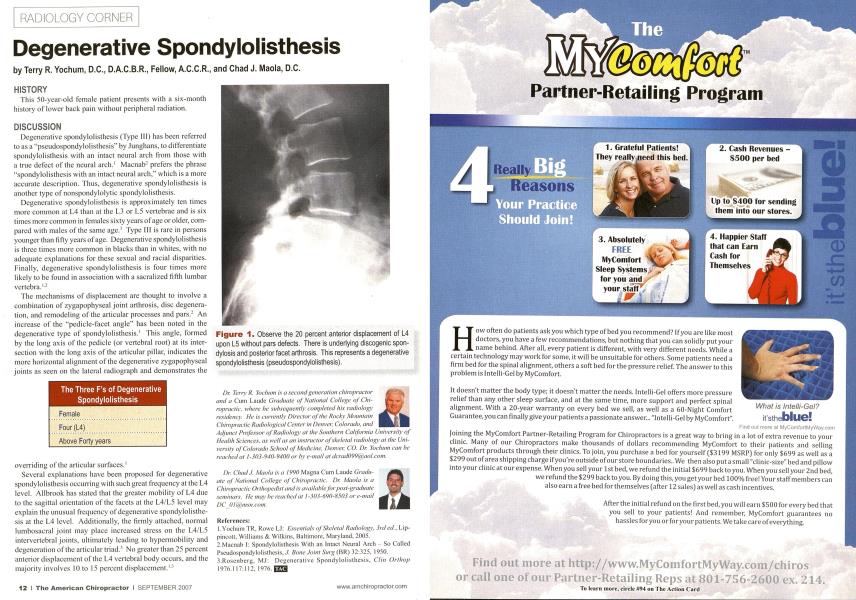 Degenerative Spondylolisthesis