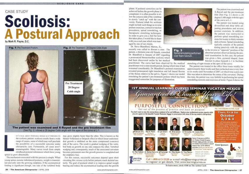 Scoliosis: A Postural Approach