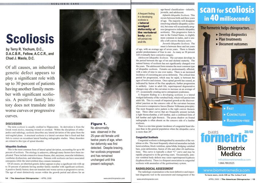 Scoliosis