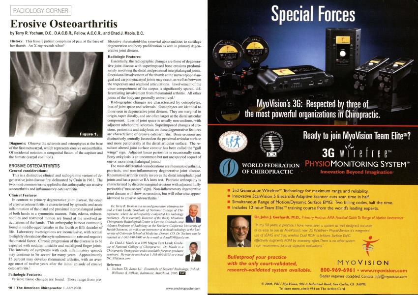 Erosive Osteoarthritis