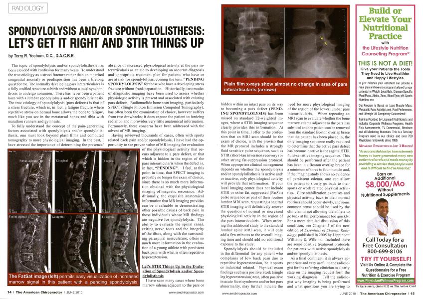 SPONDYLOLYSIS AND/OR SPONDYLOLISTHESIS: LET'S GET IT RIGHT AND STIR THINGS UP