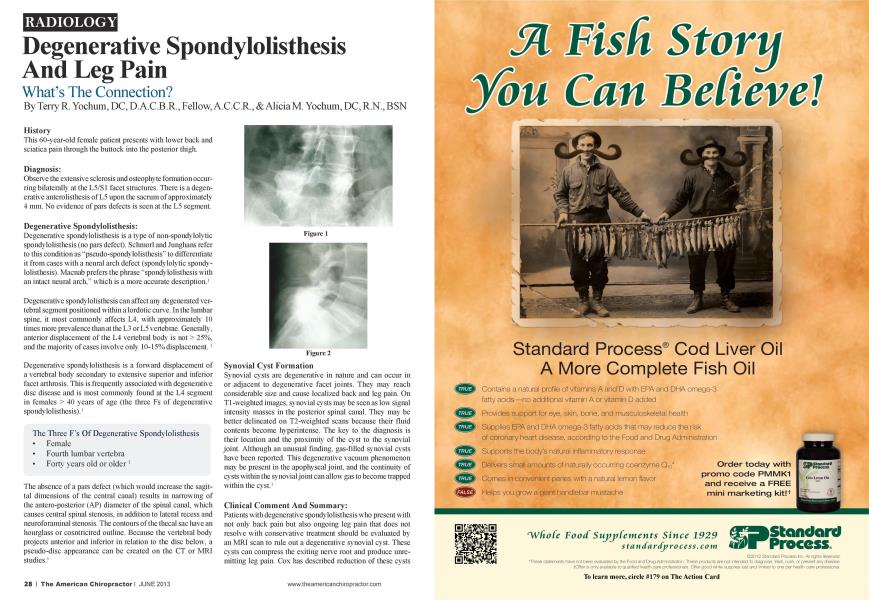 Degenerative Spondylolisthesis And Leg Pain