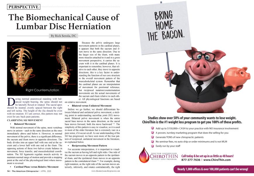 The Biomechanical Cause of Lumbar Disc Herniation