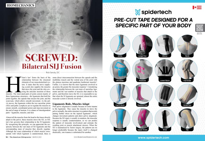 SCREWED: Bilateral SIJ Fusion